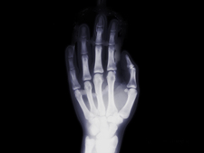 X-ray of a hand