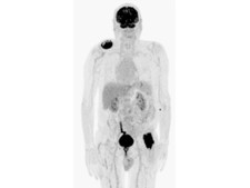 The image shows a malignant melanoma of the forehead and two soft tissue metastases right shoulder / left hip.